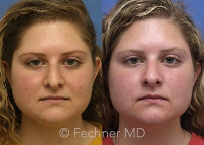 Nose Before & After Gallery - Patient 160297 - Image 1