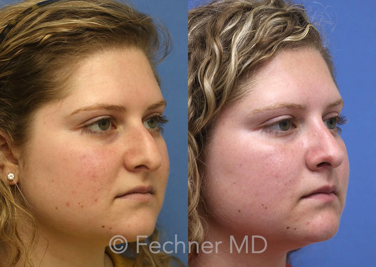 Nose Before & After Gallery - Patient 160297 - Image 2