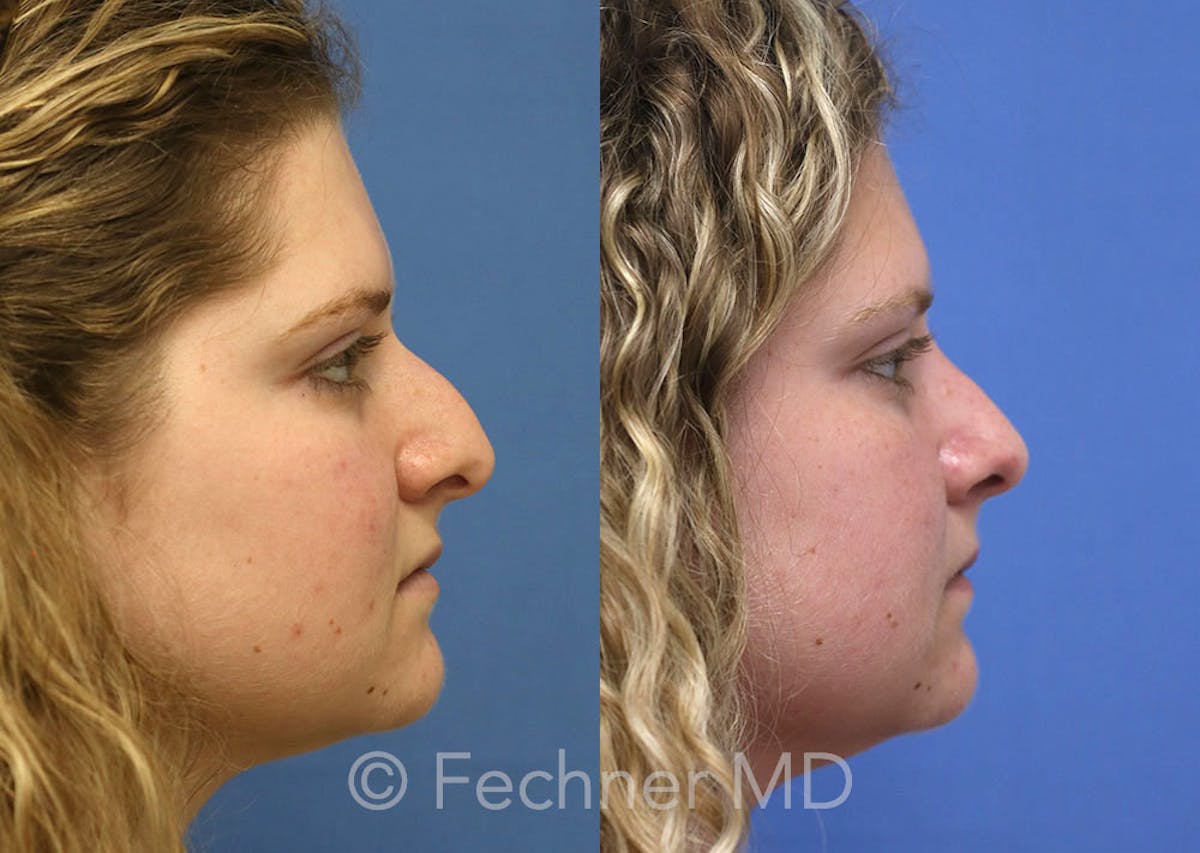 Nose Before & After Gallery - Patient 160297 - Image 3