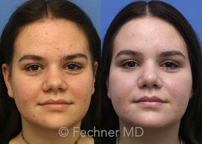Nose Before & After Gallery - Patient 398946 - Image 1