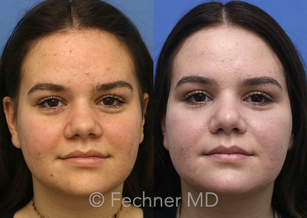 Nose Before & After Gallery - Patient 398946 - Image 1