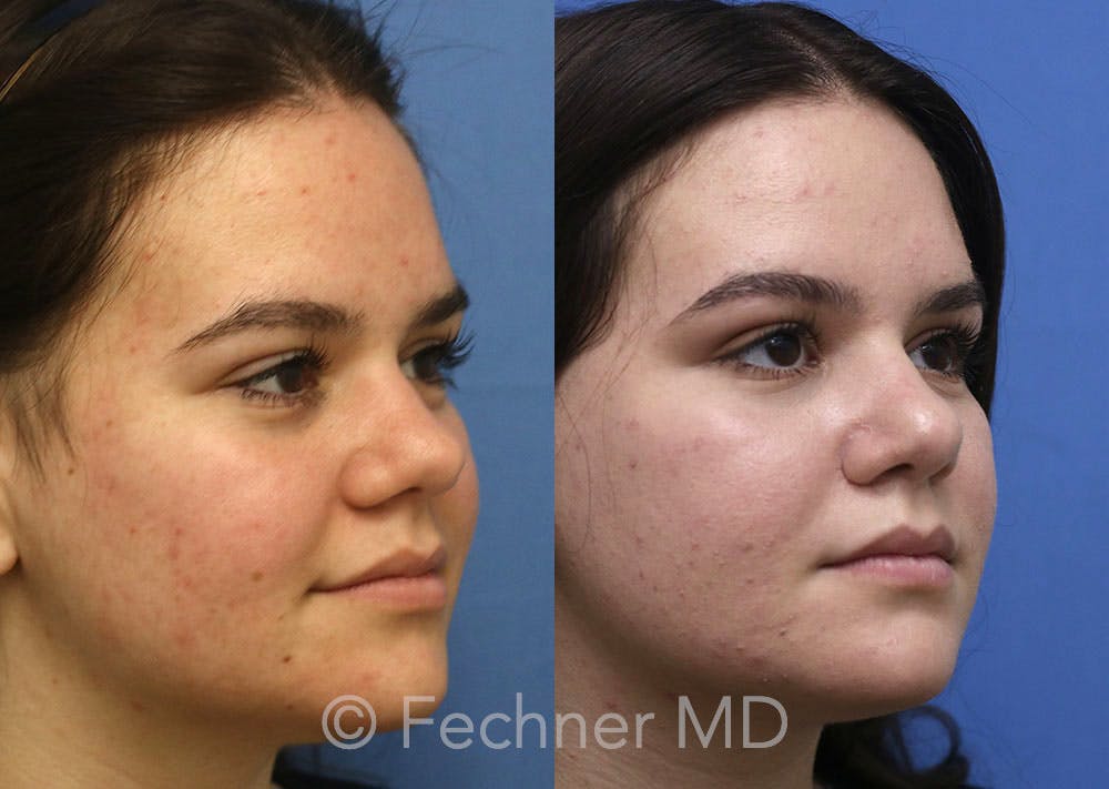 Nose Before & After Gallery - Patient 398946 - Image 2
