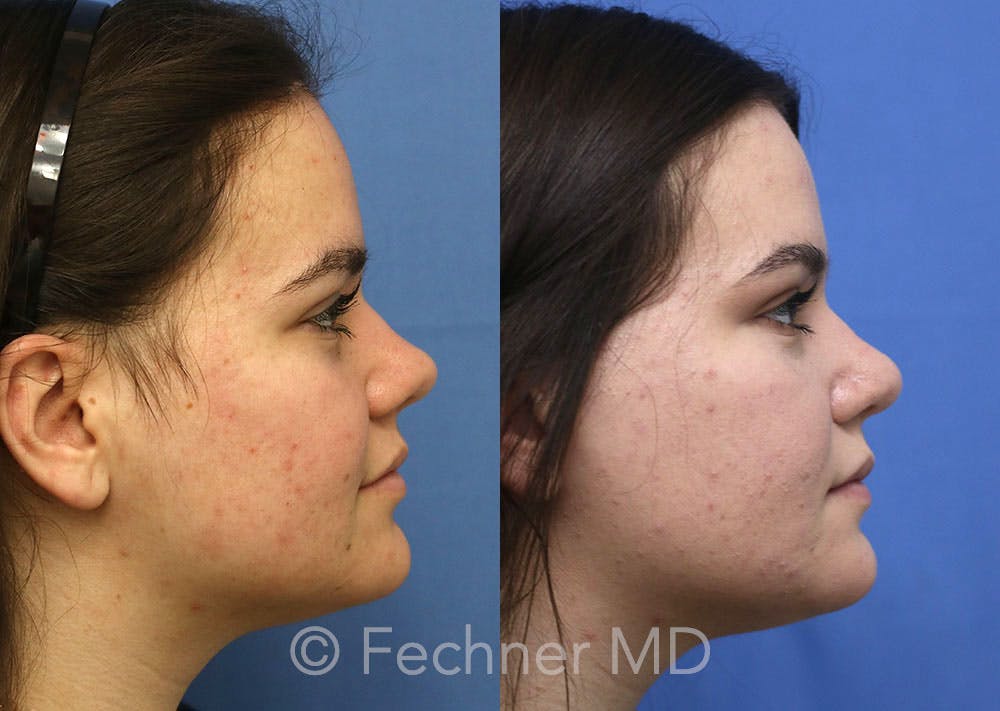 Nose Before & After Gallery - Patient 398946 - Image 3