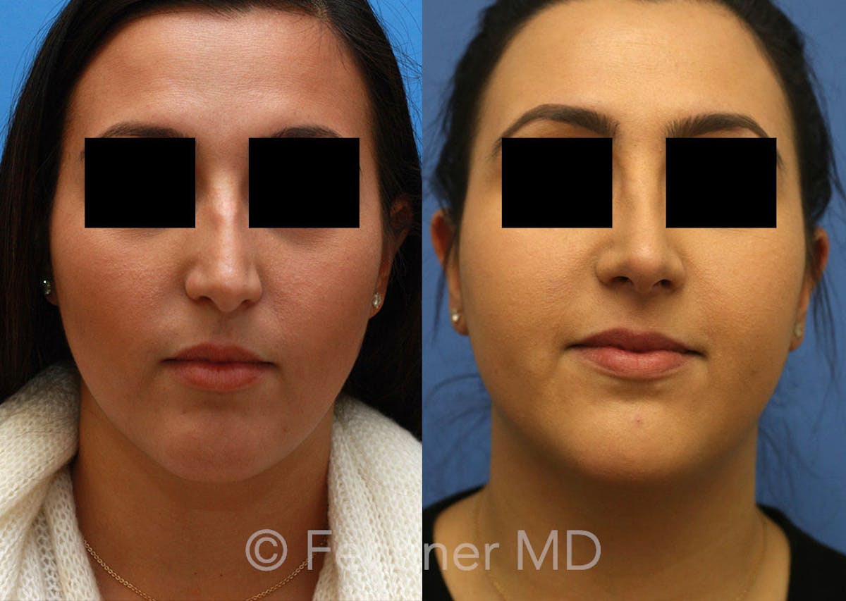 Nose Before & After Gallery - Patient 192105 - Image 1