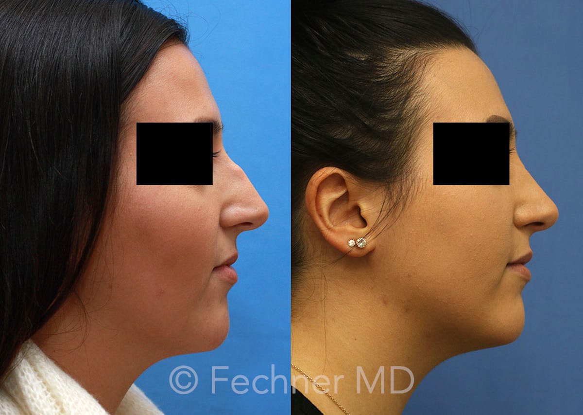 Nose Before & After Gallery - Patient 192105 - Image 2
