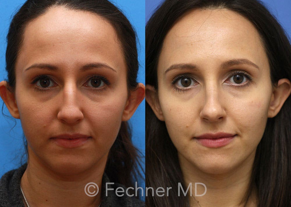 Nose Before & After Gallery - Patient 374380 - Image 1