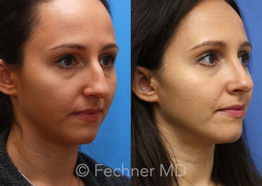Nose Before & After Gallery - Patient 374380 - Image 2