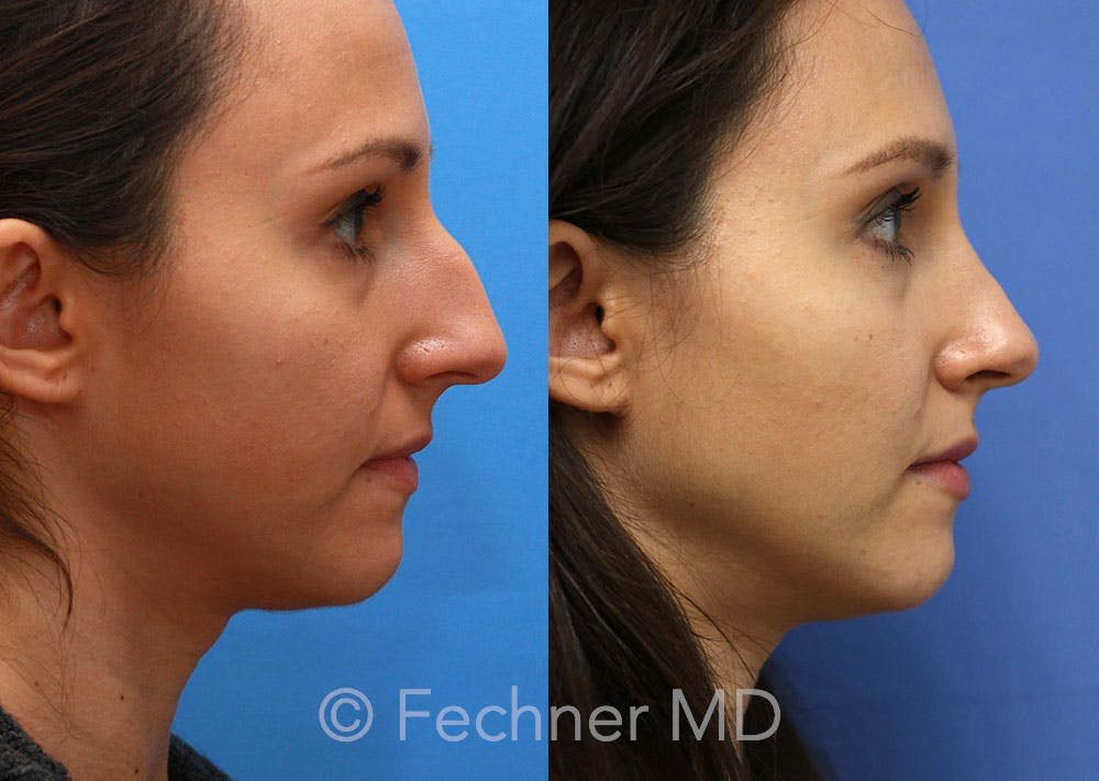 Nose Before & After Gallery - Patient 374380 - Image 3
