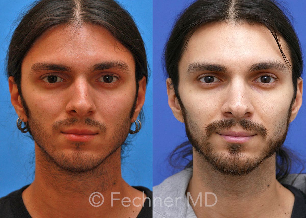 Nose Before & After Gallery - Patient 272909 - Image 1