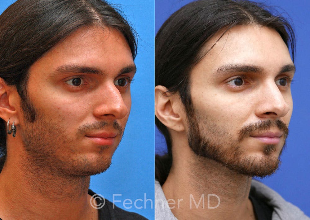 Nose Before & After Gallery - Patient 272909 - Image 2