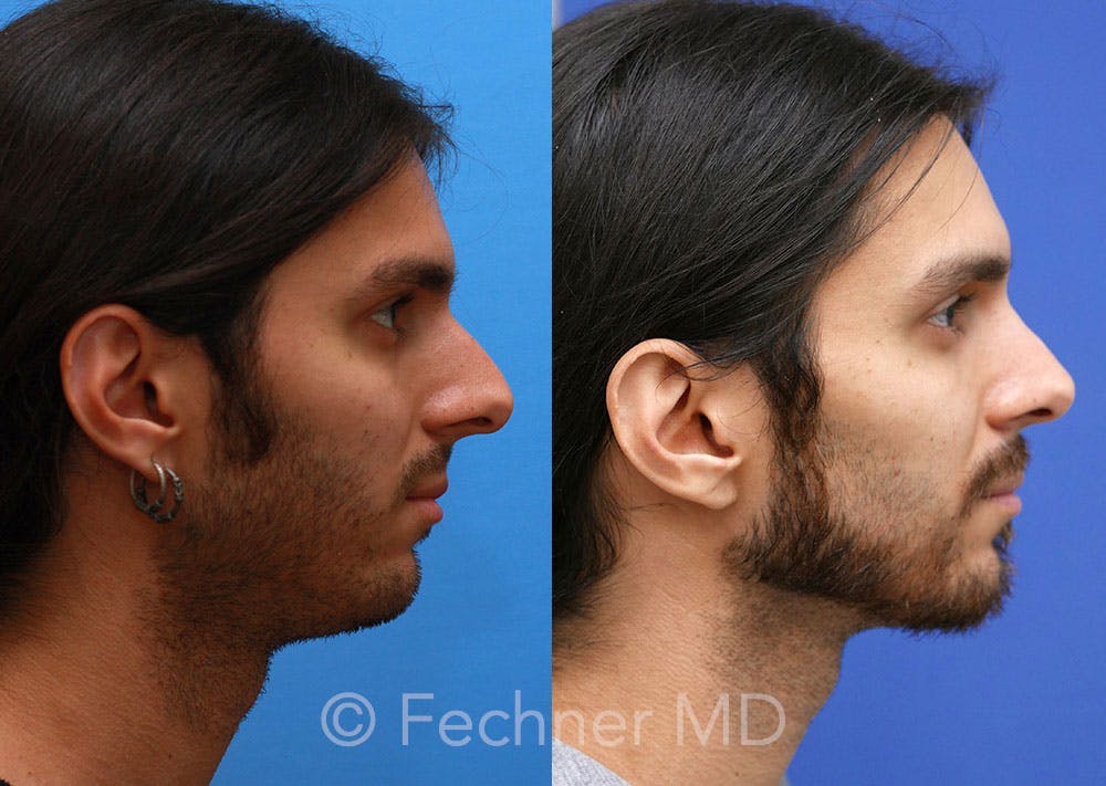 Nose Before & After Gallery - Patient 272909 - Image 3