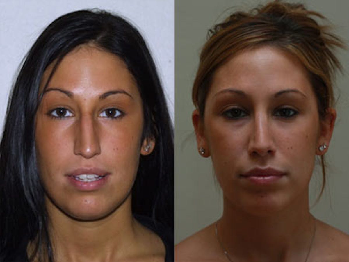 Nose Before & After Gallery - Patient 207066 - Image 1