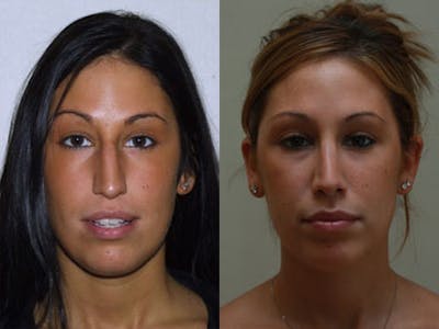 Nose Before & After Gallery - Patient 207066 - Image 1