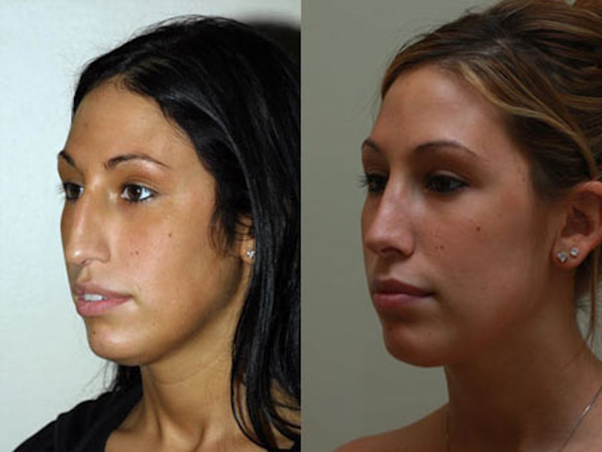 Nose Before & After Gallery - Patient 207066 - Image 2