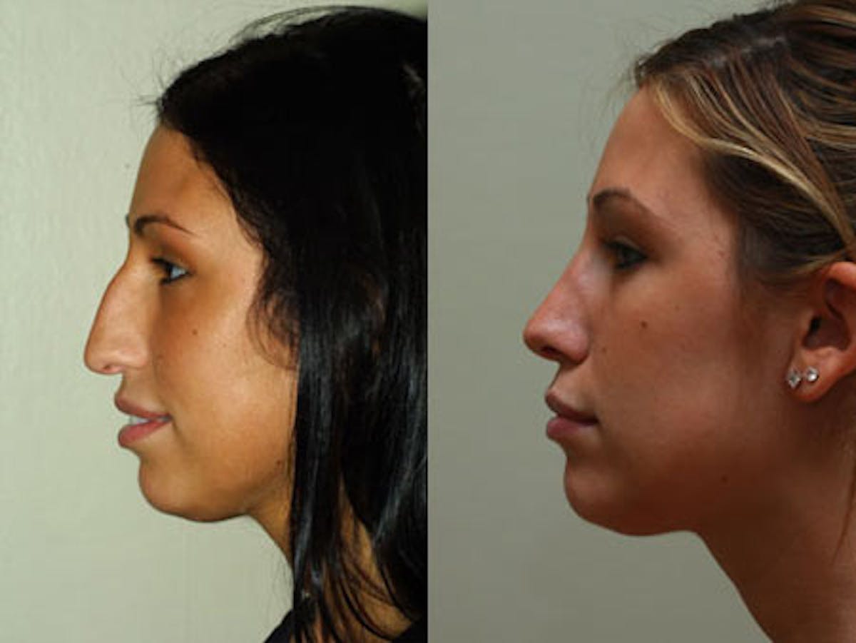 Nose Before & After Gallery - Patient 207066 - Image 3