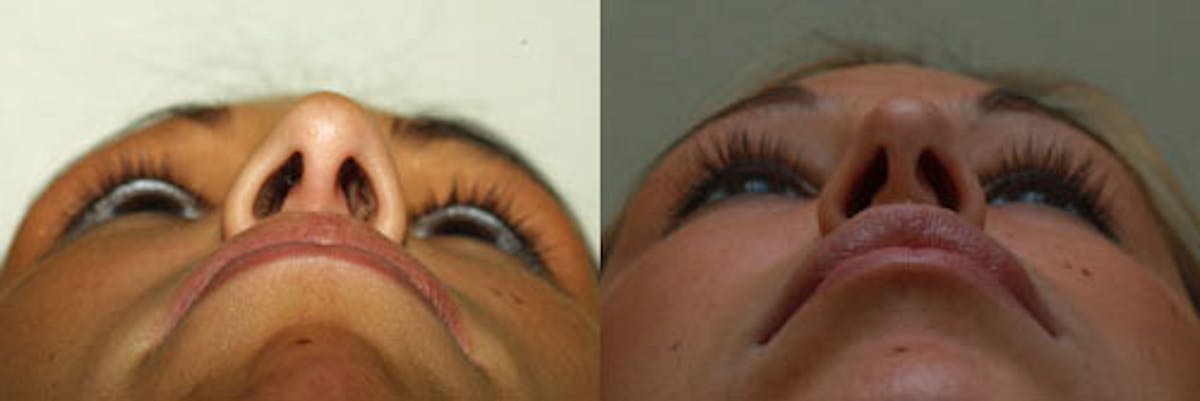 Nose Before & After Gallery - Patient 207066 - Image 4
