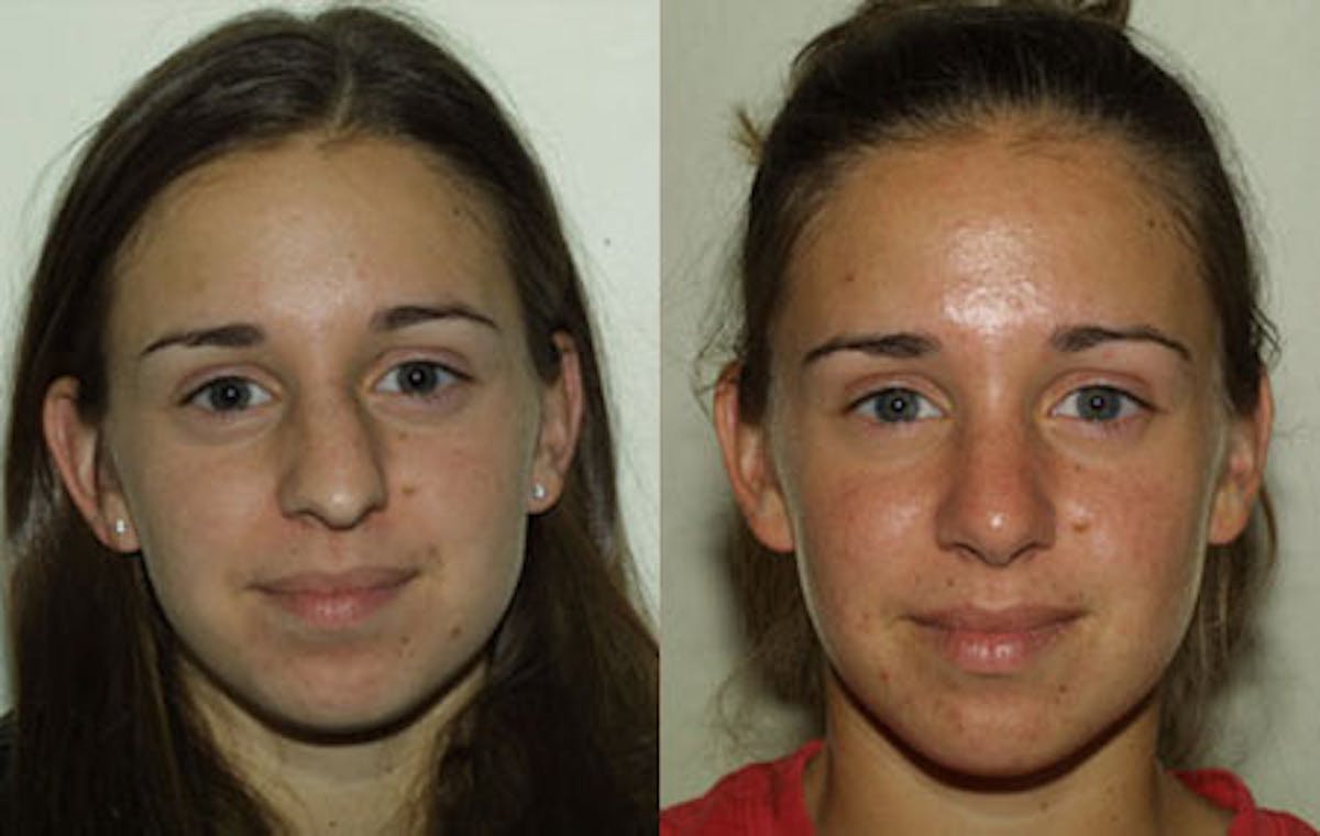 Nose Before & After Gallery - Patient 209260 - Image 1