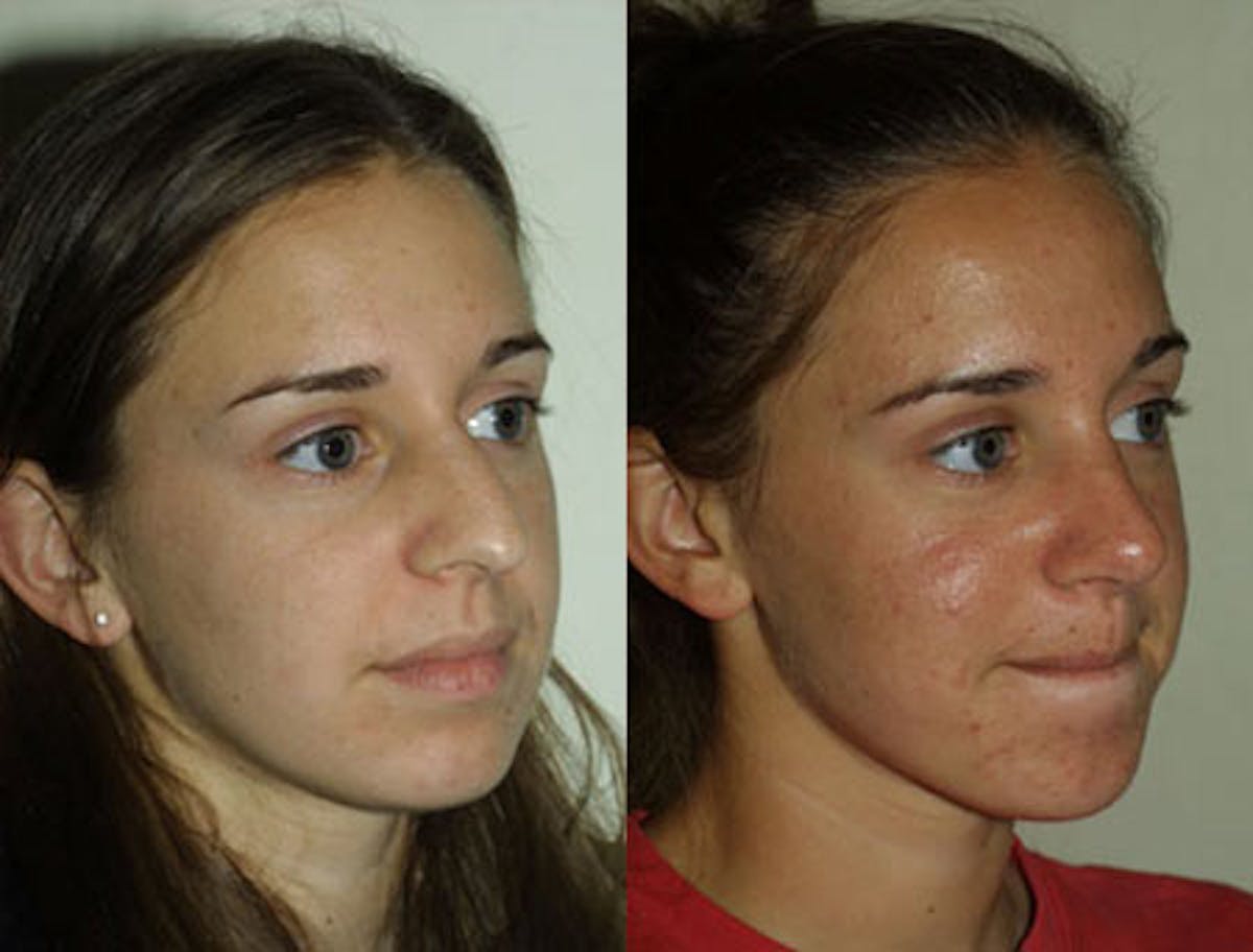 Nose Before & After Gallery - Patient 209260 - Image 2