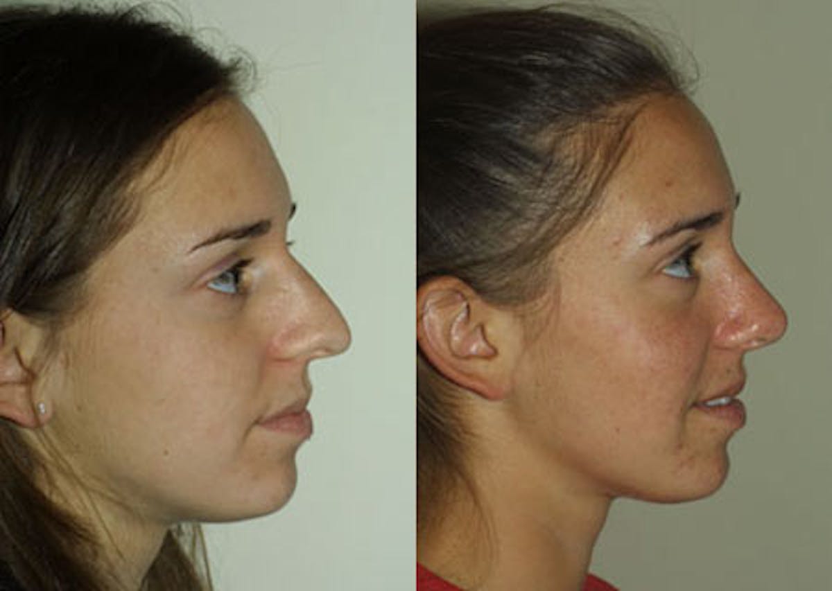 Nose Before & After Gallery - Patient 209260 - Image 3