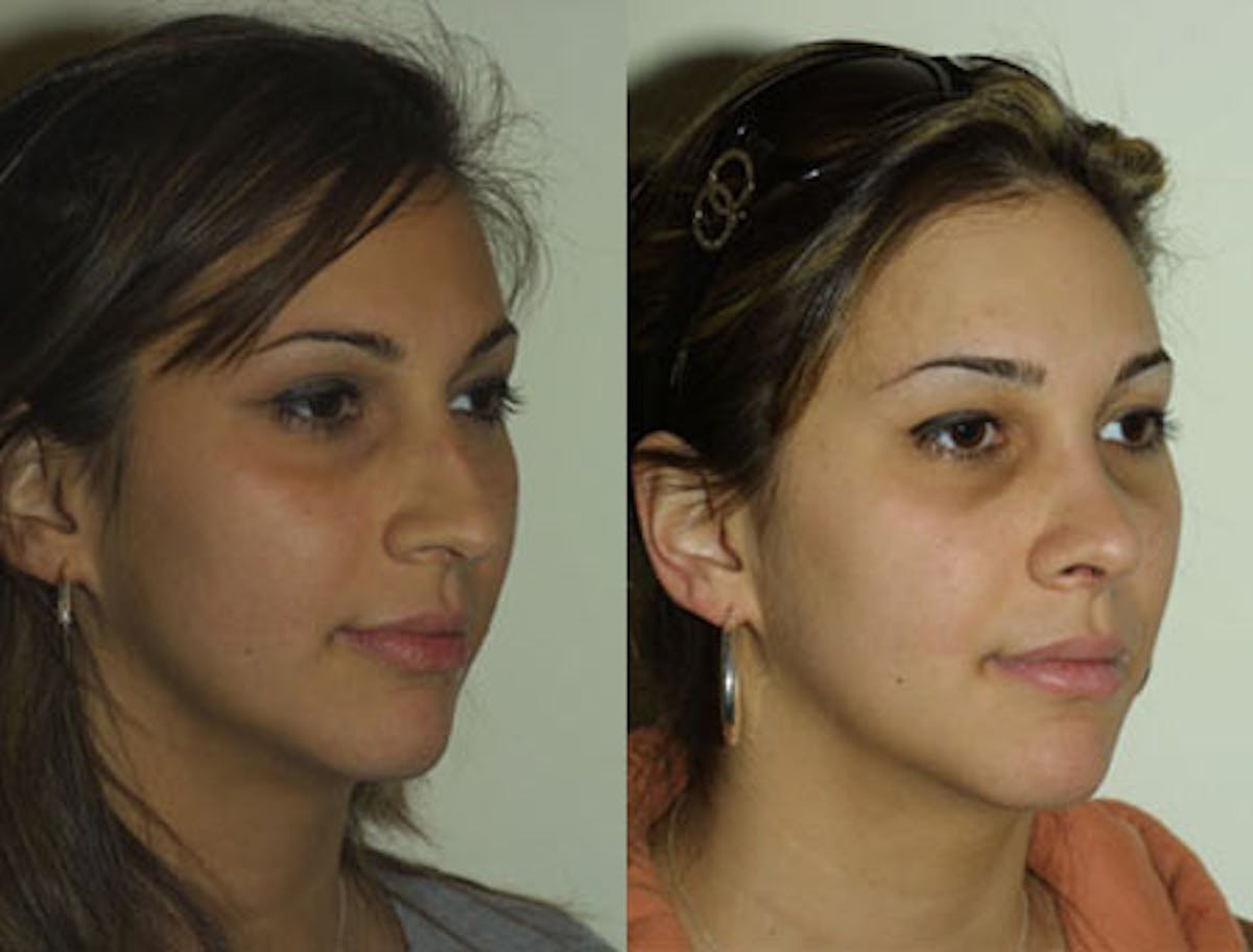 Nose Before & After Gallery - Patient 284137 - Image 1