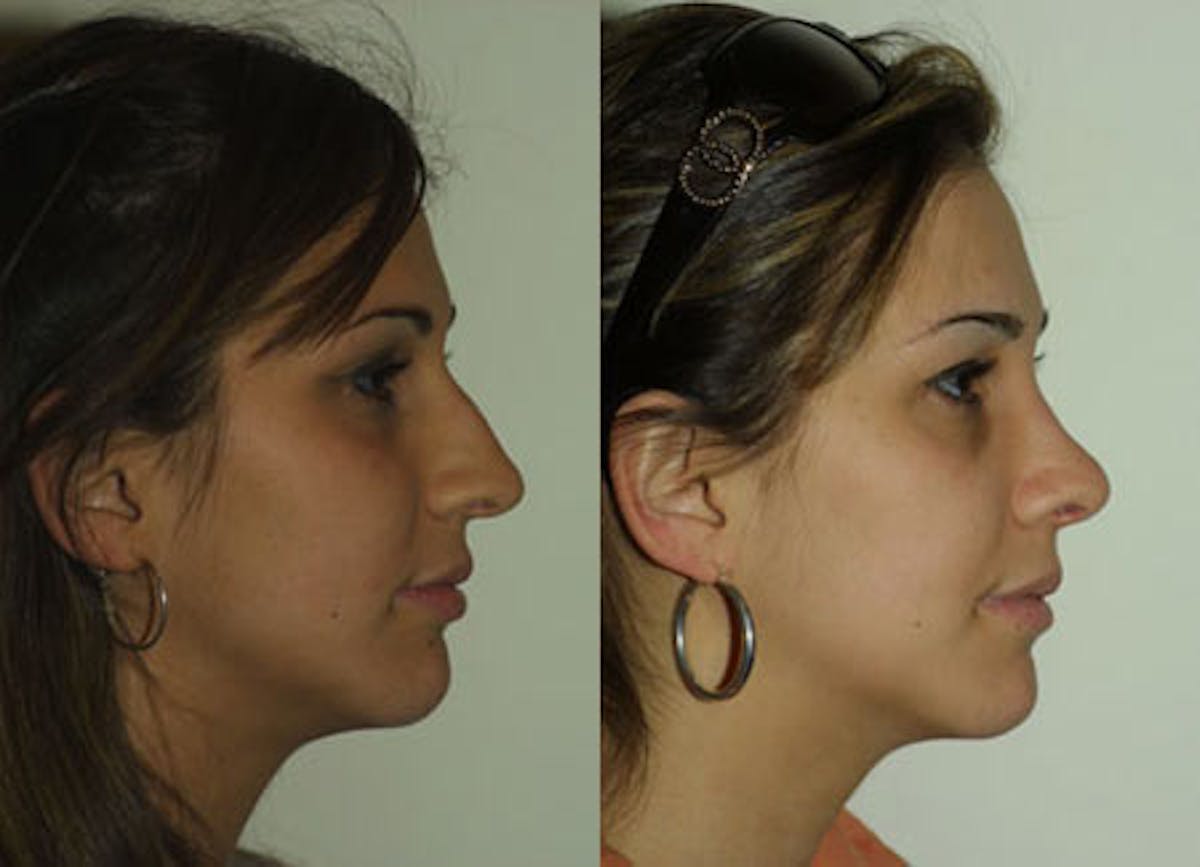 Nose Before & After Gallery - Patient 284137 - Image 2