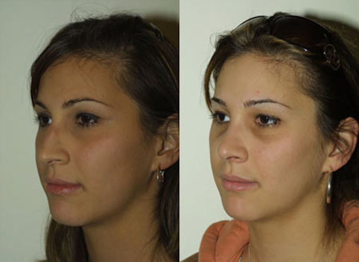 Nose Before & After Gallery - Patient 284137 - Image 3