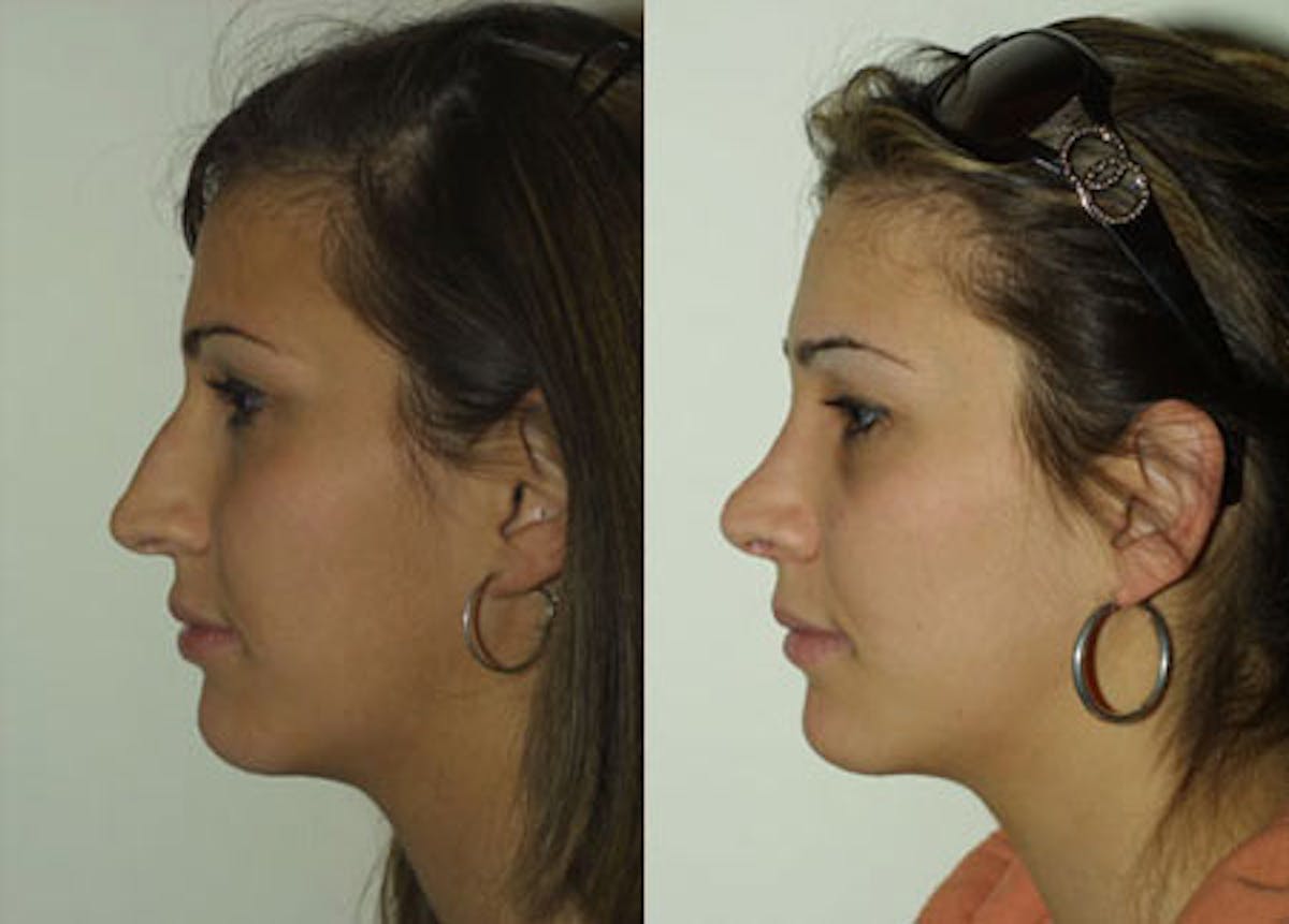 Nose Before & After Gallery - Patient 284137 - Image 4