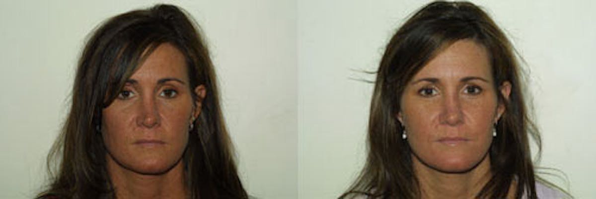 Nose Before & After Gallery - Patient 222018 - Image 1