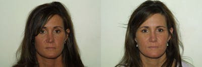Nose Before & After Gallery - Patient 222018 - Image 1