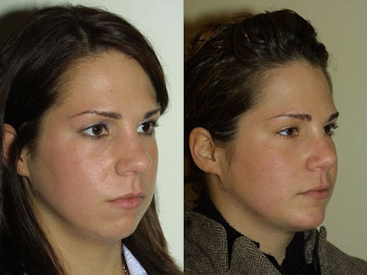 Nose Before & After Gallery - Patient 153566 - Image 1