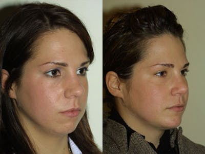 Nose Before & After Gallery - Patient 153566 - Image 1