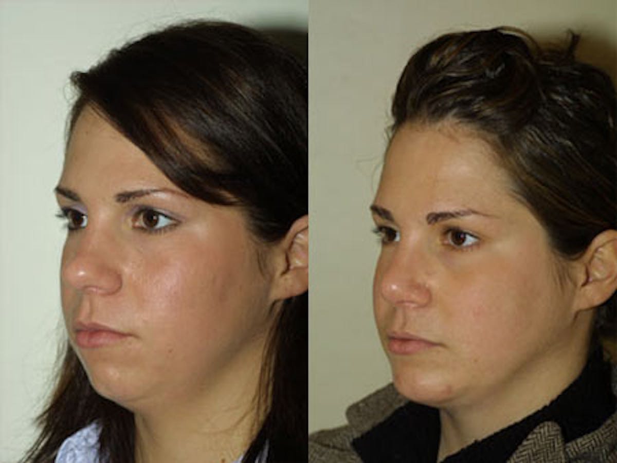 Nose Before & After Gallery - Patient 153566 - Image 2