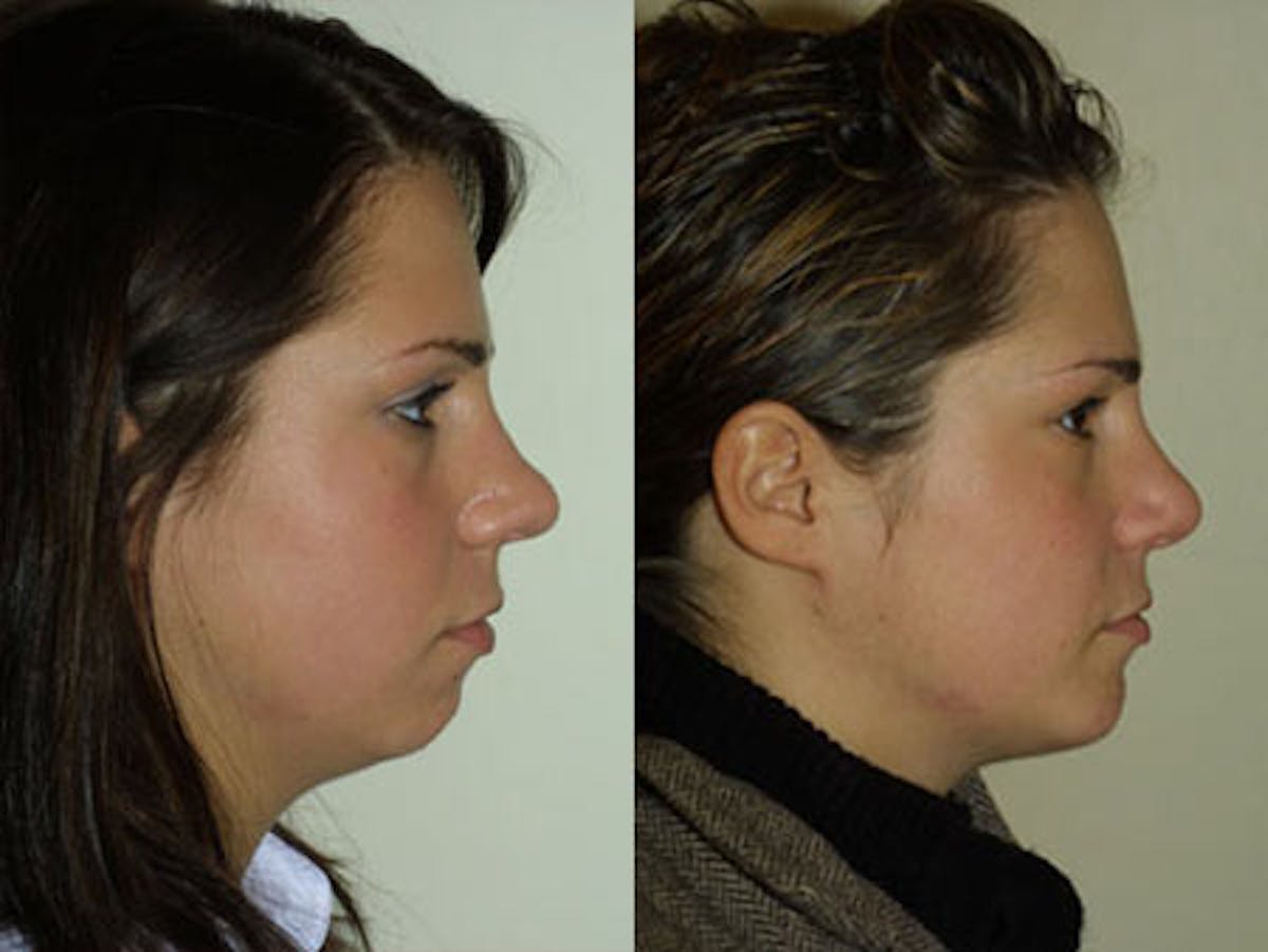 Nose Before & After Gallery - Patient 153566 - Image 3