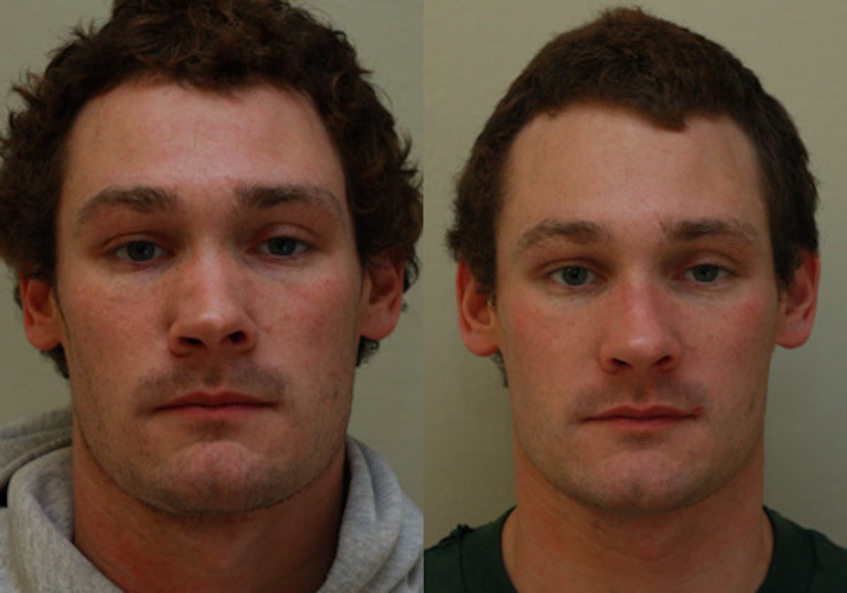 Nose Before & After Gallery - Patient 396897 - Image 1