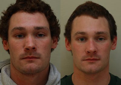 Nose Before & After Gallery - Patient 396897 - Image 1