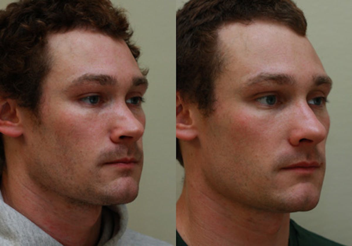 Nose Before & After Gallery - Patient 396897 - Image 2