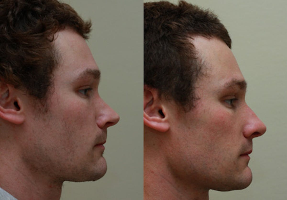 Nose Before & After Gallery - Patient 396897 - Image 3