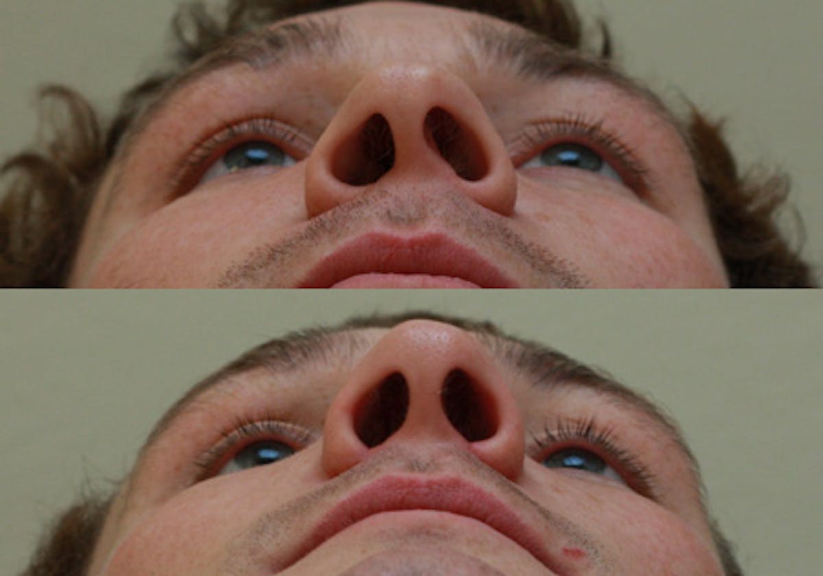 Nose Before & After Gallery - Patient 396897 - Image 4