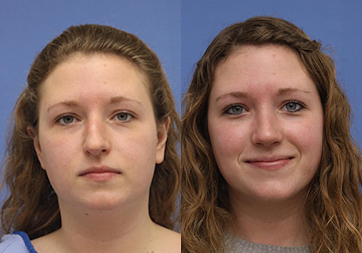 Nose Before & After Gallery - Patient 161913 - Image 1