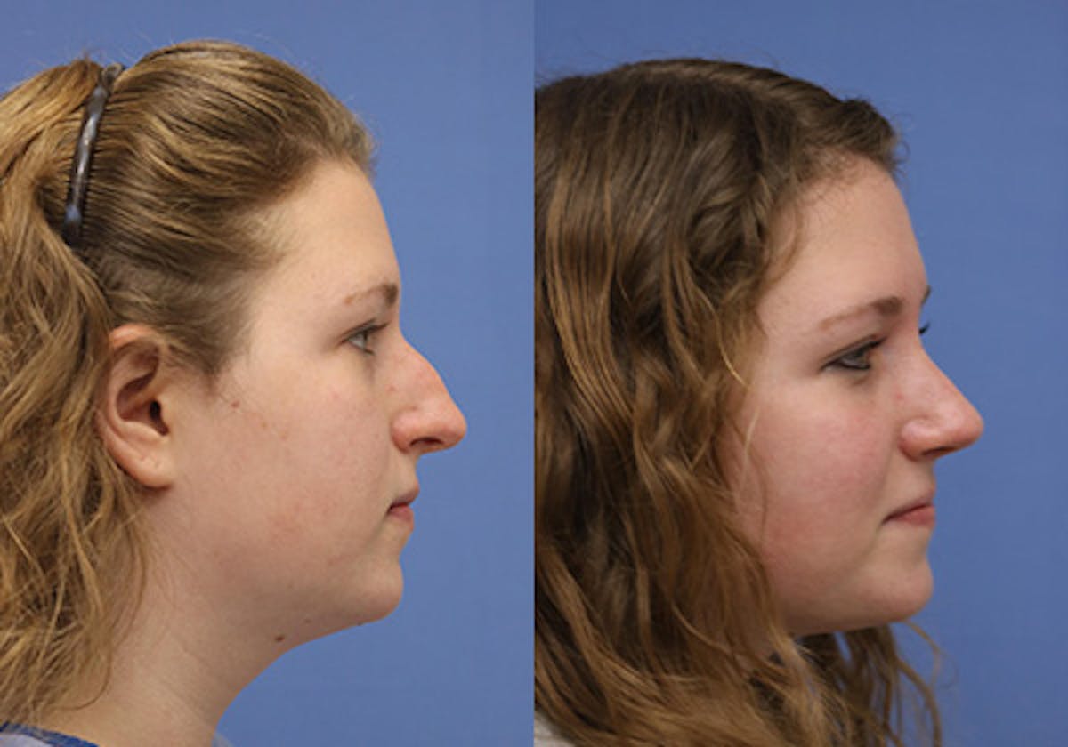 Nose Before & After Gallery - Patient 161913 - Image 2