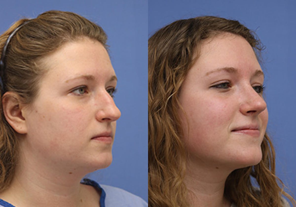 Nose Before & After Gallery - Patient 161913 - Image 3