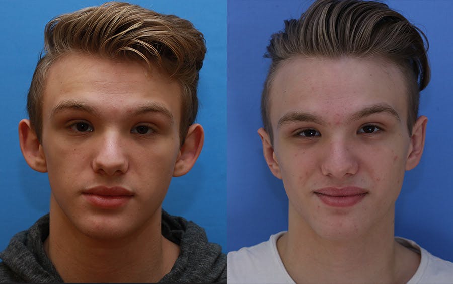 Otoplasty Before & After Gallery - Patient 197766 - Image 1