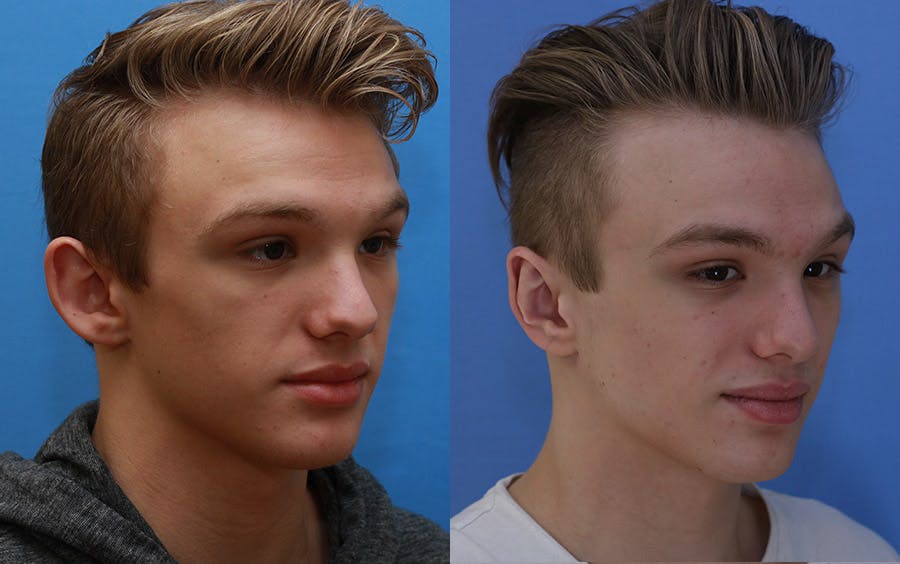 Otoplasty Before & After Gallery - Patient 197766 - Image 2