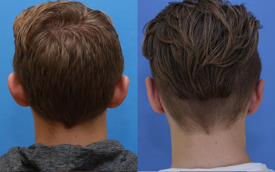 Otoplasty Before & After Gallery - Patient 197766 - Image 3