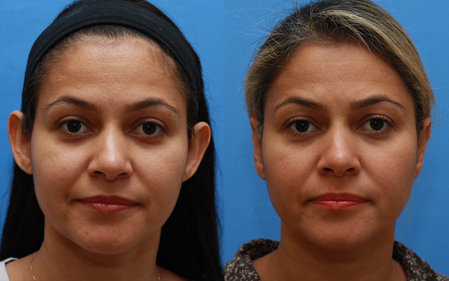 Otoplasty Before & After Gallery - Patient 797026 - Image 1