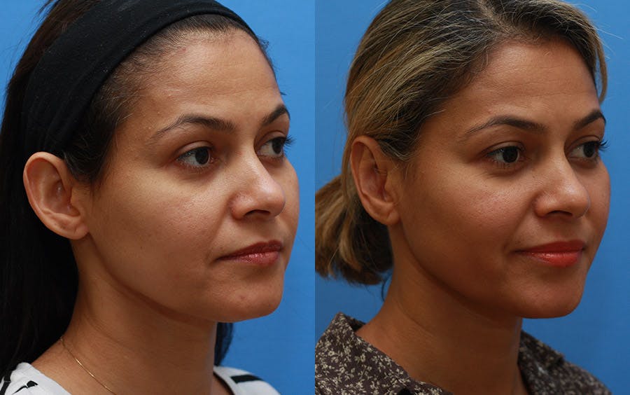 Otoplasty Before & After Gallery - Patient 797026 - Image 2