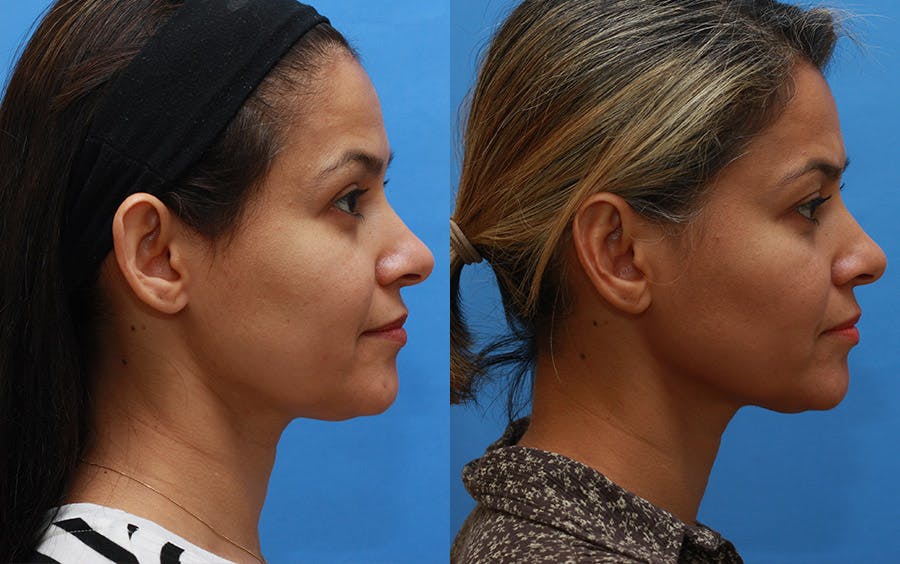Otoplasty Before & After Gallery - Patient 797026 - Image 3