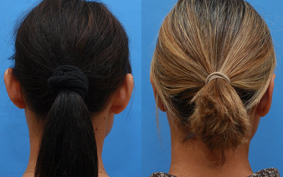 Otoplasty Before & After Gallery - Patient 797026 - Image 4