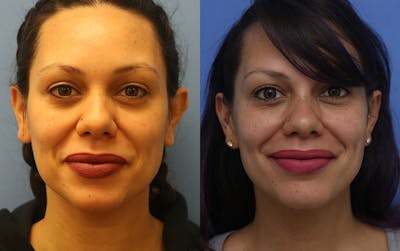 Otoplasty Before & After Gallery - Patient 115575 - Image 1