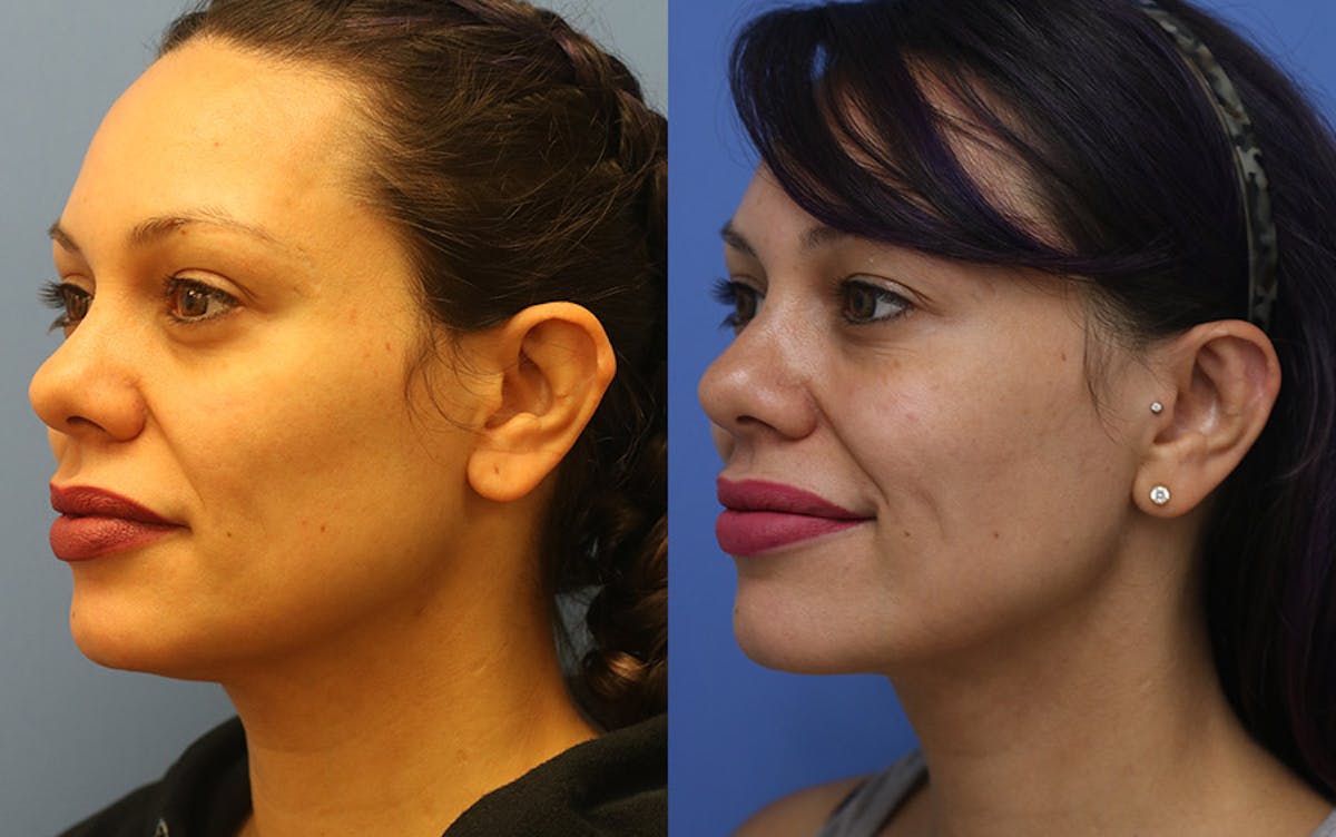 Otoplasty Before & After Gallery - Patient 115575 - Image 2